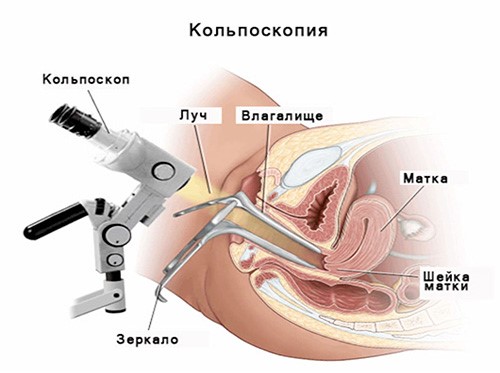 Кольпоскопия